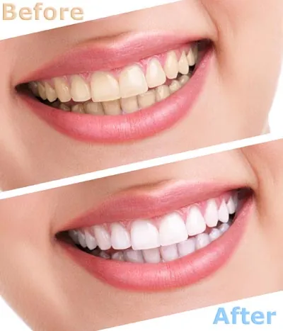 before and after look at a patient's smile thanks to teeth whitening